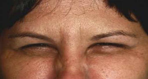 BOTOX 2 AFTER