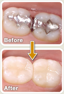 Before/After Crowns