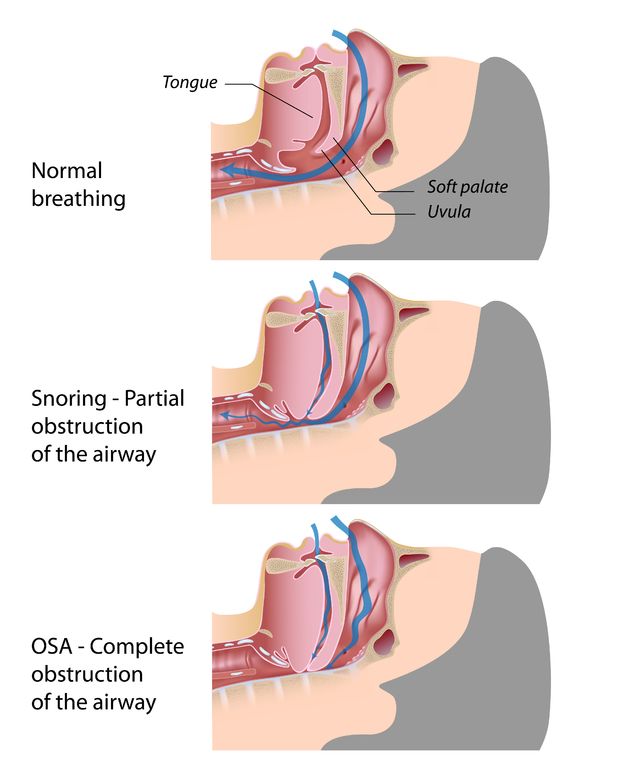 snoring or sleep apnea