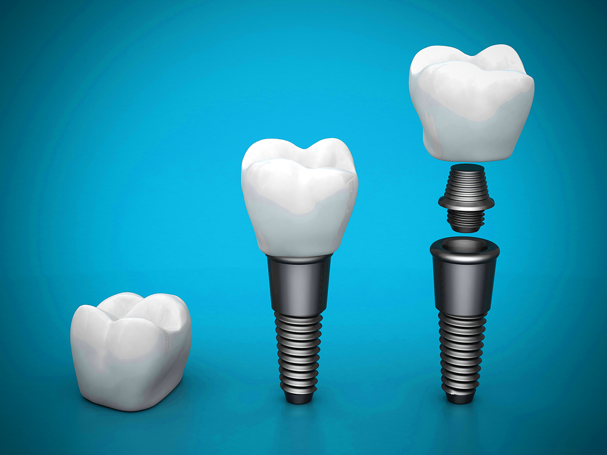 Dental implants - Eagle Harbor Dentist
