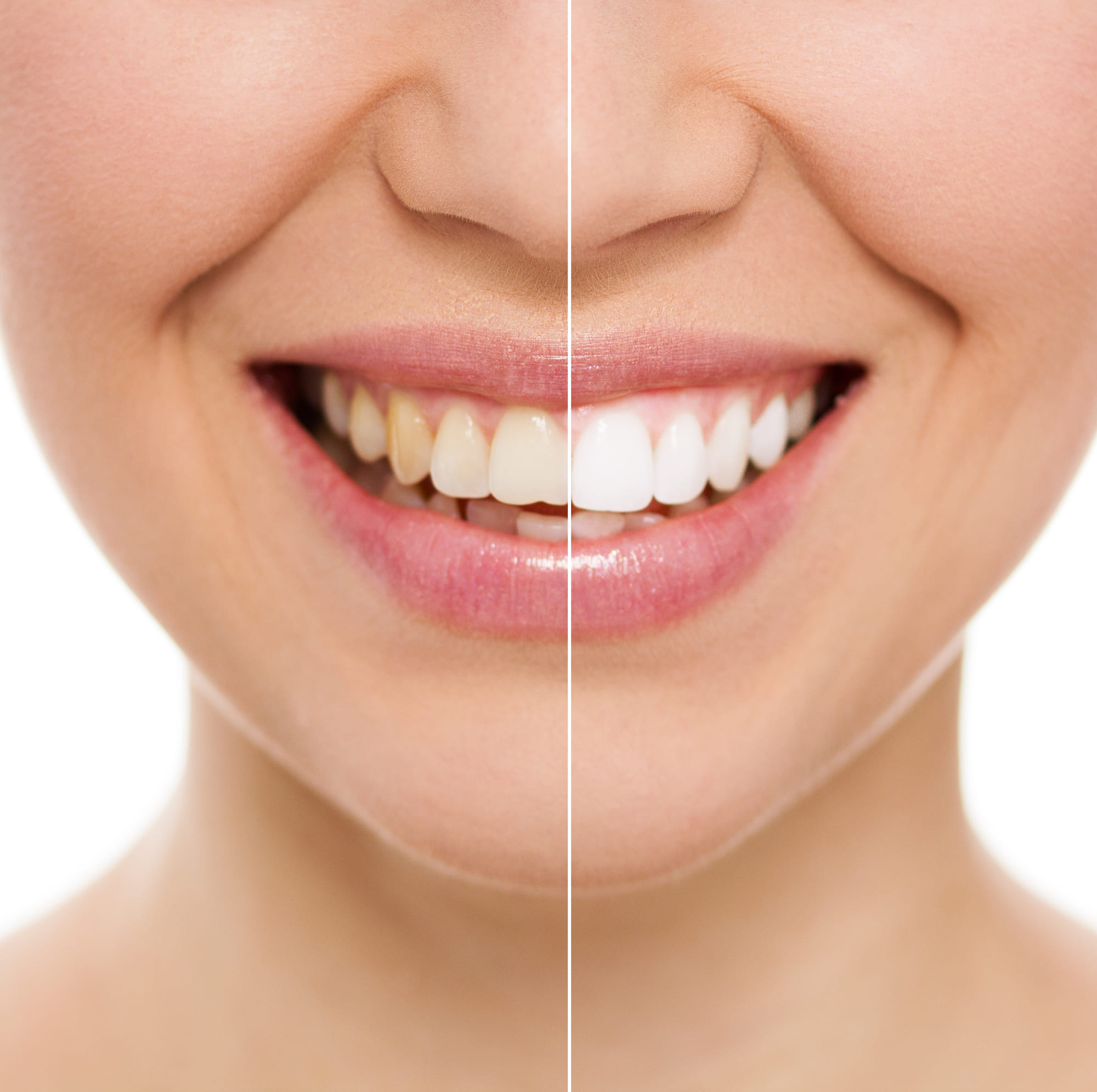 Before and after of teeth whitening treatment