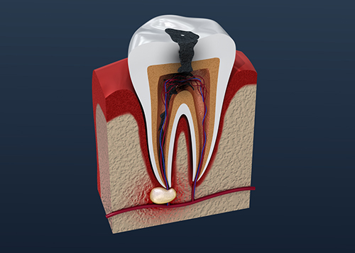 Tooth decay illustration