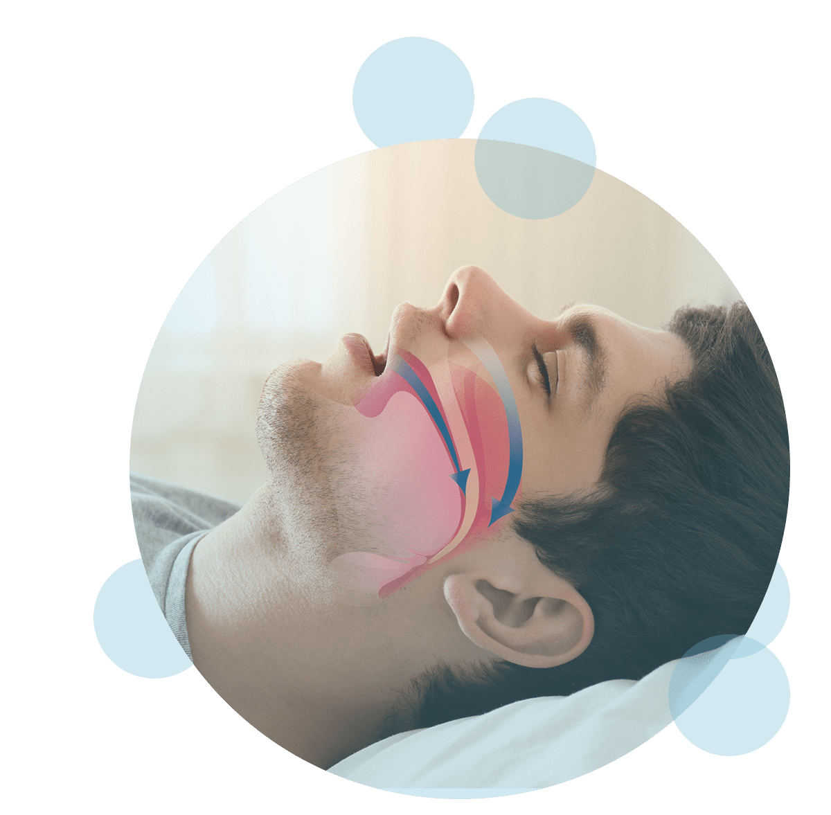 Sleep apnea illustrated image