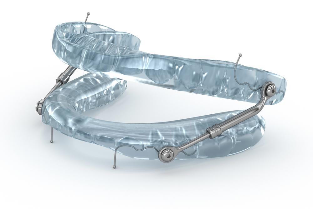Oral appliance used to help treat obstructive sleep apnea