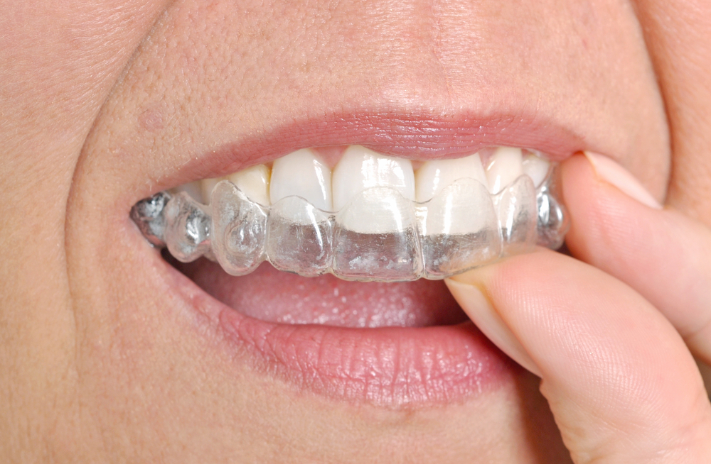 a person putting an Invisalign aligner onto their teeth