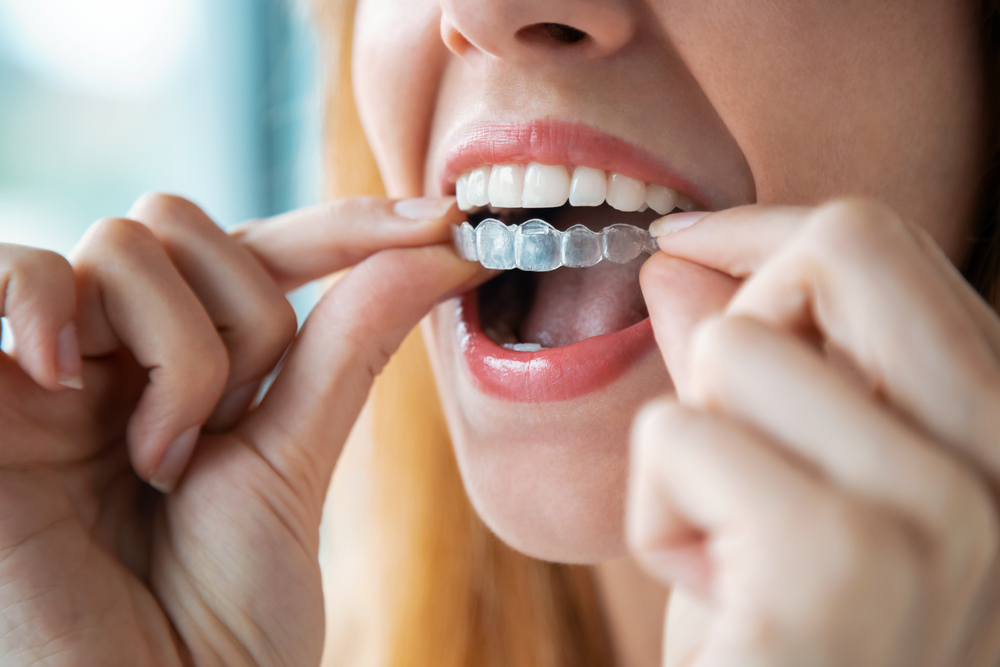 a woman inserting an Invisalign aligner onto her teeth