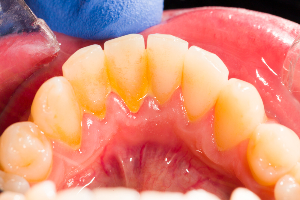 yellow plaque buildup near the gums on the back of the front bottom teeth in a mouth