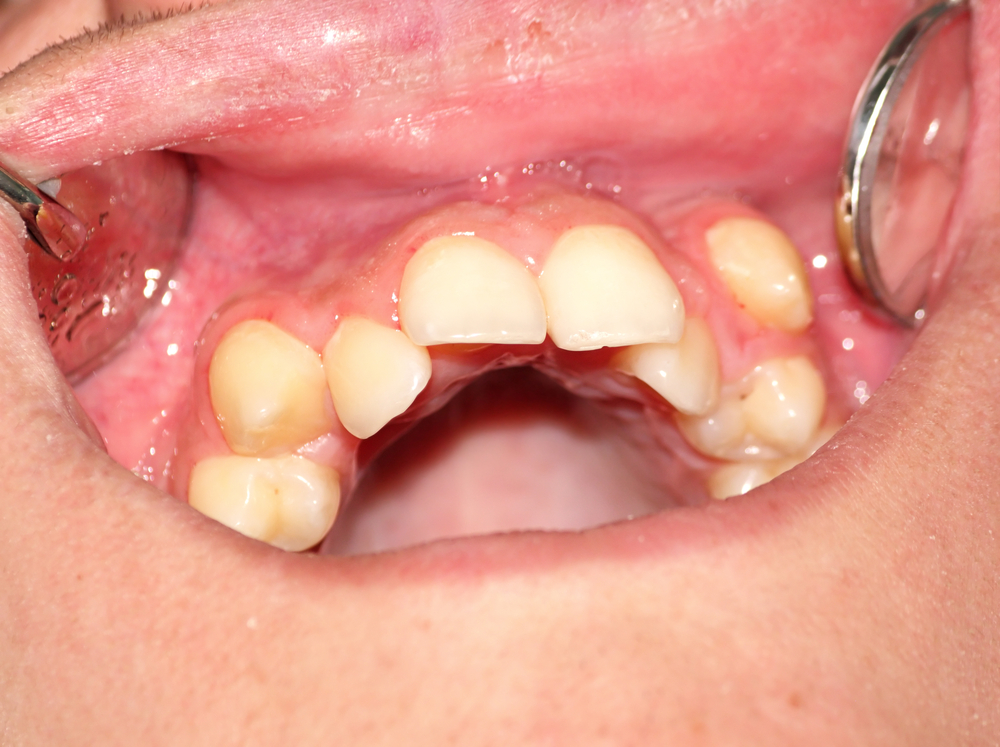 crowded upper teeth being examined by a dentist