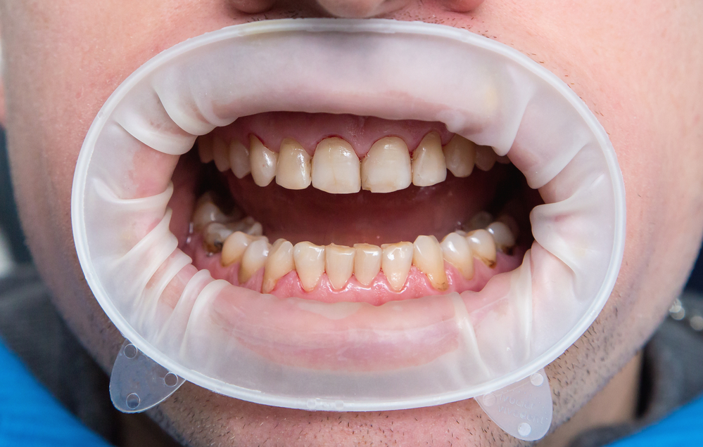 a closeup of a mouth with fluorosis that caused tooth discoloration