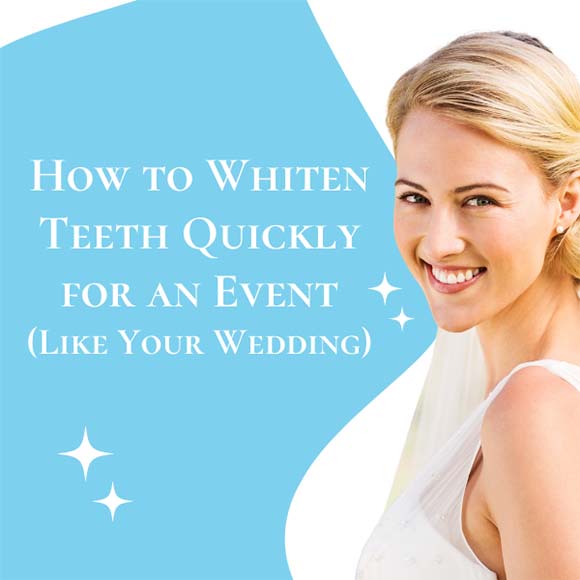 How to Whiten Teeth Quickly for an Event (Like Your Wedding)