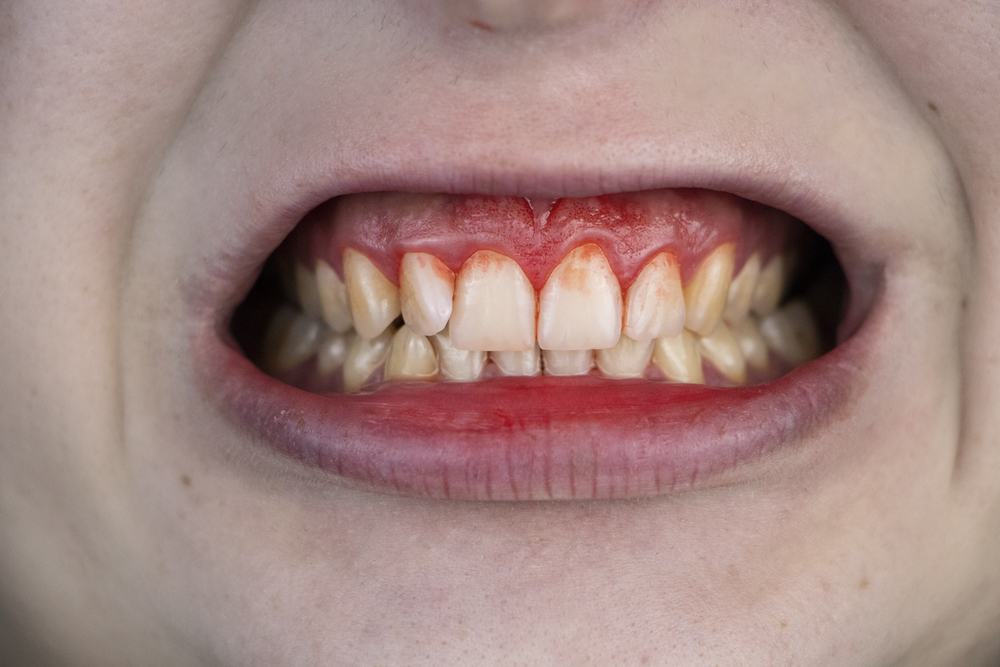 a close-up on a person’s mouth with gum disease