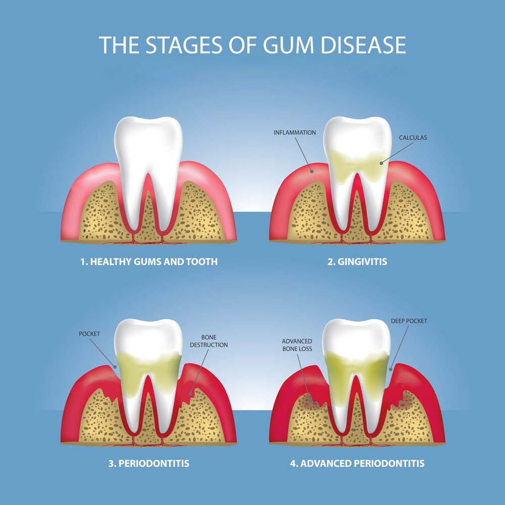 A vector depicting the various stages of gum disease.