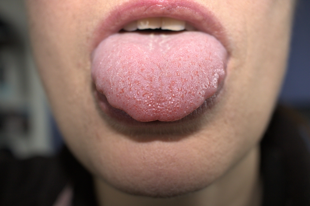 Swollen enlarged white tongue