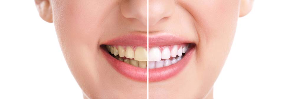 Side-by-side image of a woman smiling, one side yellow teeth, one side white teeth