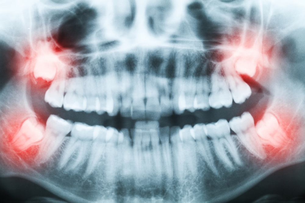 Closeup of x-ray image of teeth and mouth with all four wisdom teeth molars highlighted in red.