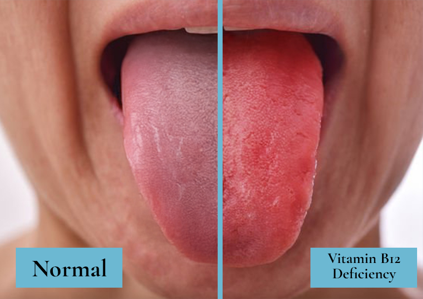 B12 Deficiency Tongue Look Like